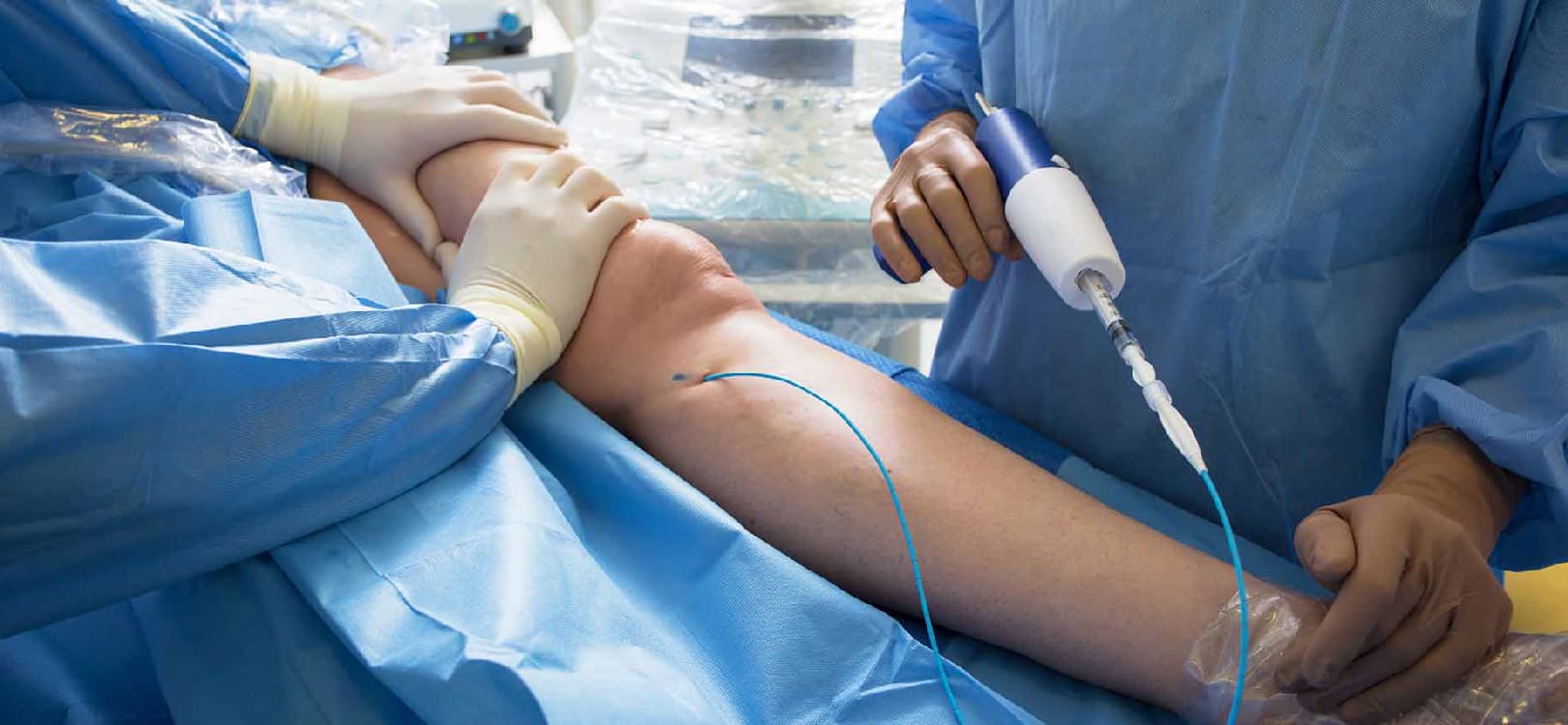 Varicose Veins - Glue
